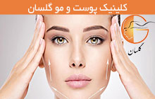 لیفت نخ در رشت